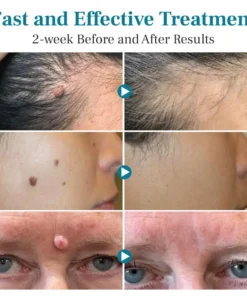 DIYSTAR™ LumeSkin Mole and Wart Removal Laser Pen