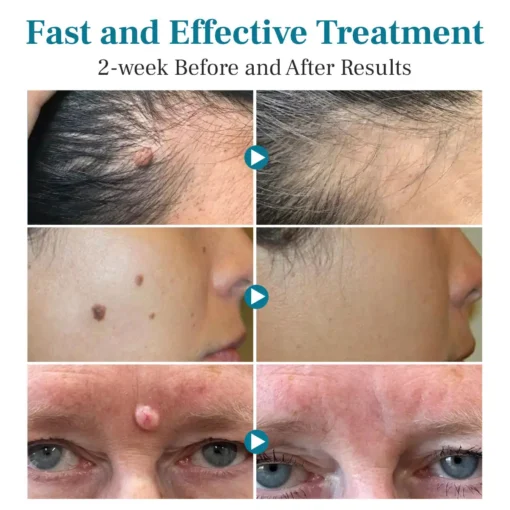 DIYSTAR™ LumeSkin Mole and Wart Removal Laser Pen