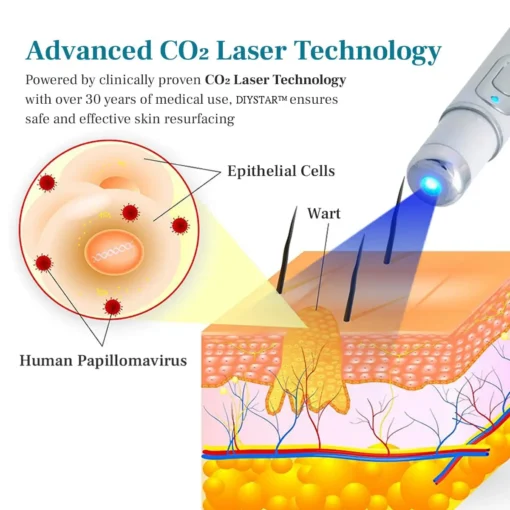 DIYSTAR™ LumeSkin Mole and Wart Removal Laser Pen