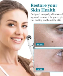 DIYSTAR™ LumeSkin Mole and Wart Removal Laser Pen