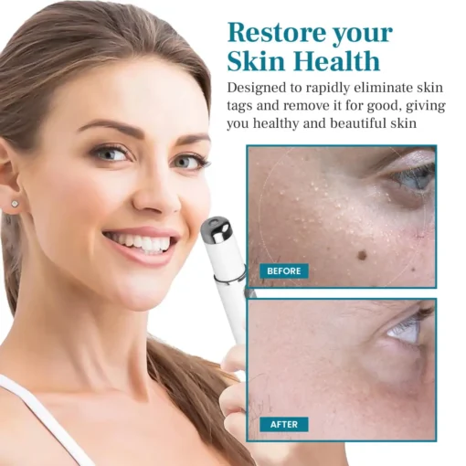 DIYSTAR™ LumeSkin Mole and Wart Removal Laser Pen