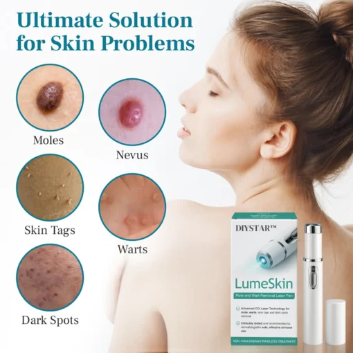 DIYSTAR™ LumeSkin Mole and Wart Removal Laser Pen