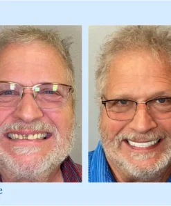 DIYSTAR™ Custom-Fit Functional Dentures
