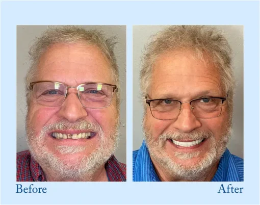 DIYSTAR™ Custom-Fit Functional Dentures