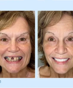DIYSTAR™ Custom-Fit Functional Dentures