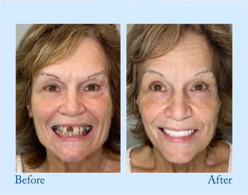DIYSTAR™ Custom-Fit Functional Dentures