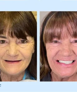 DIYSTAR™ Custom-Fit Functional Dentures