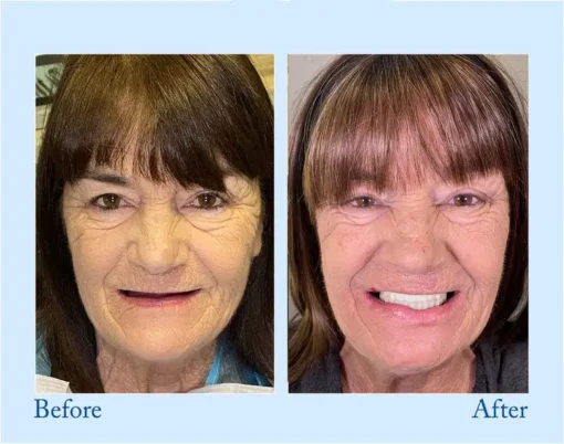 DIYSTAR™ Custom-Fit Functional Dentures