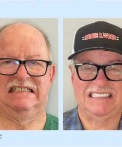 DIYSTAR™ Custom-Fit Functional Dentures