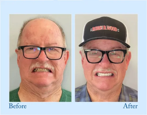 DIYSTAR™ Custom-Fit Functional Dentures